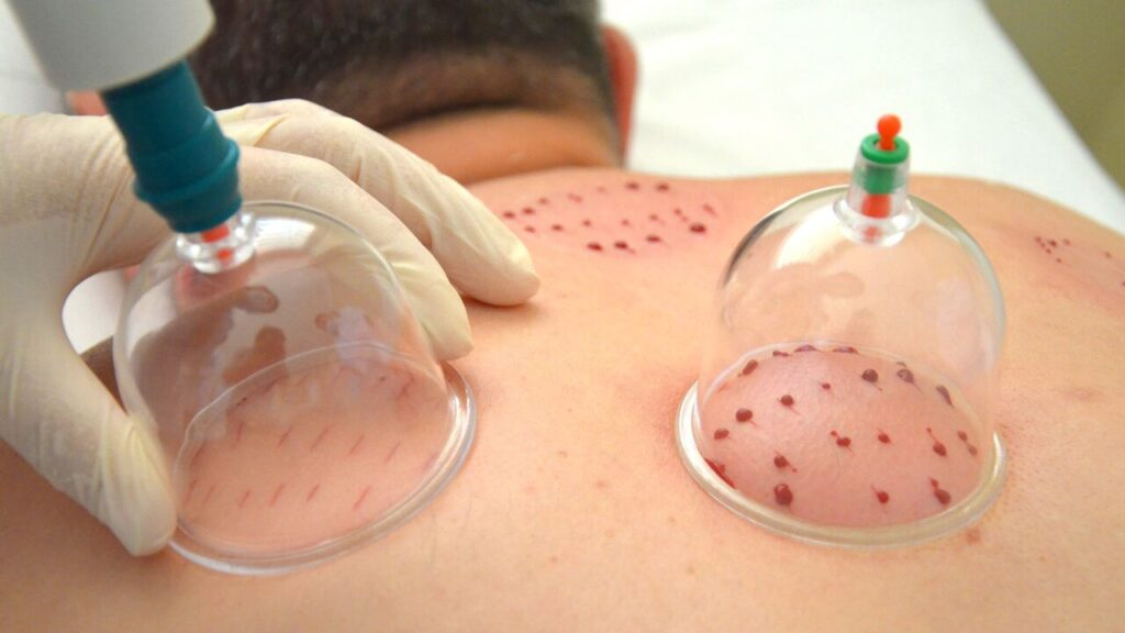 Cupping Therapy